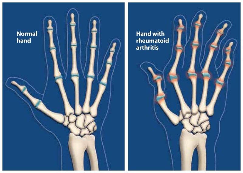 Hand-with-rheumatoid-arthritis1.jpg