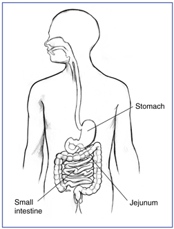 digestive-Gastroparesis.jpg