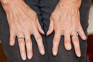 scleroderma hand involvement